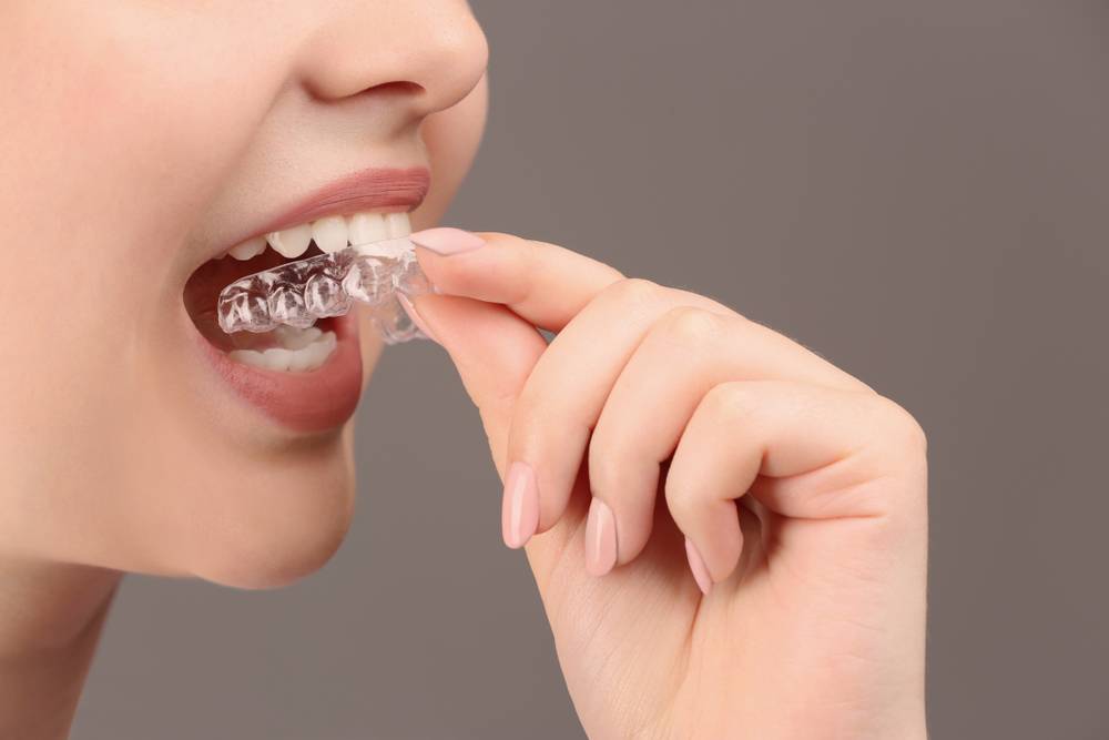 Comment appliquer le gel de blanchiment dentaire ?-1