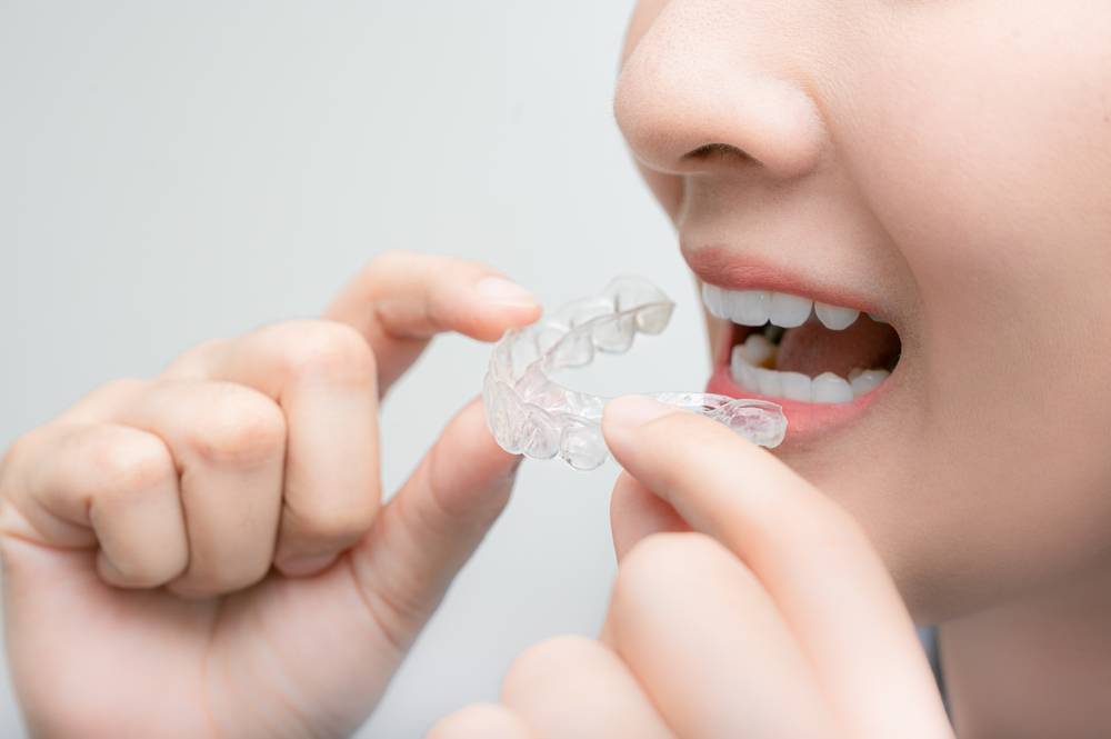Comment appliquer le gel de blanchiment dentaire ?-2