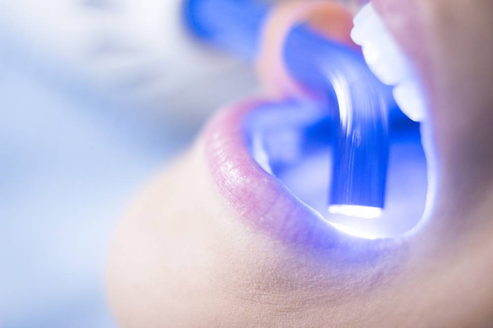 Quelles sont les différentes méthodes de blanchiment dentaire ?-2