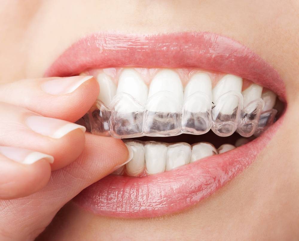 Quels sont les meilleurs kits de blanchiment dentaire ?-2