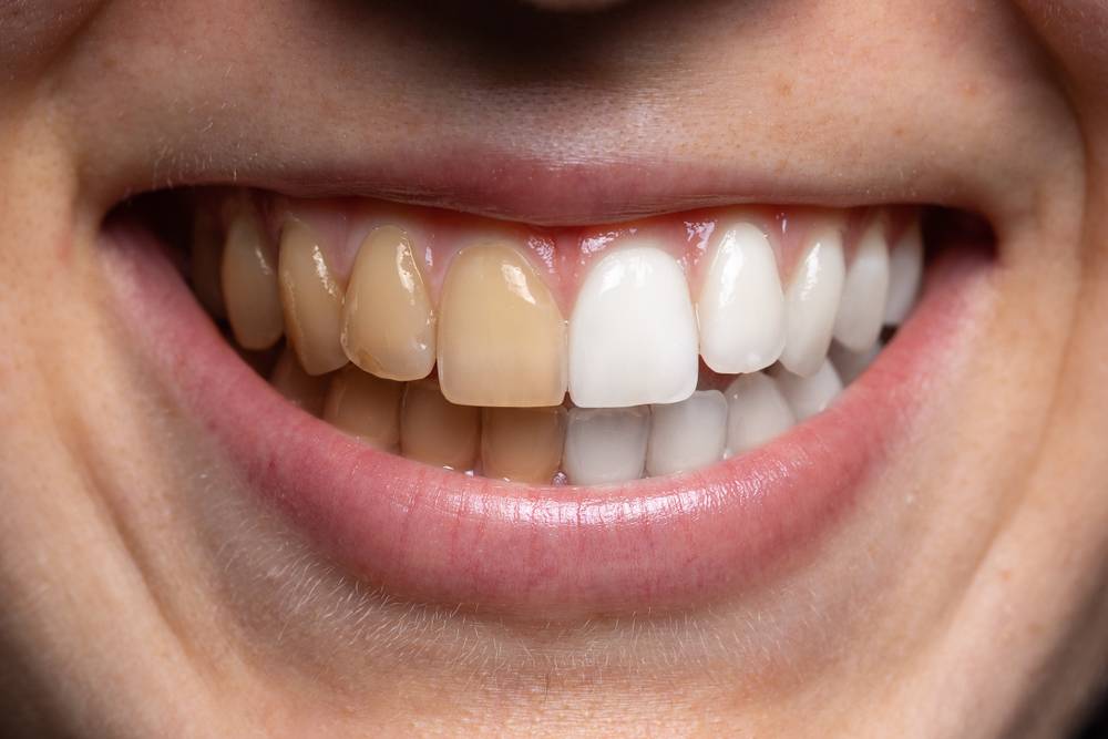 Recourir au blanchiment dentaire pour améliorer son sourire-2