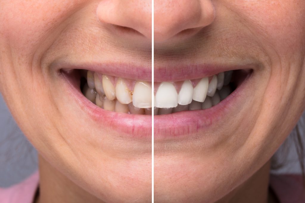 Resultados de branqueamento dos dentes: antes e depois com WHITECARE