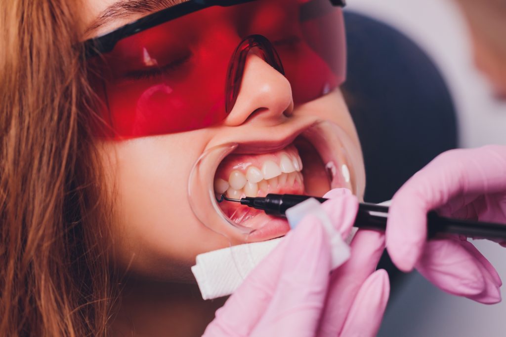 O que é branqueamento dos dentes americanos?
