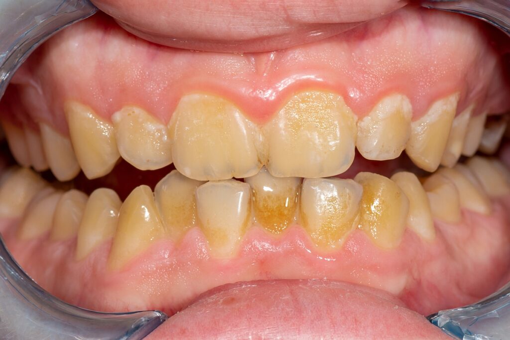 Dents jaunes : pourquoi et comment avoir des dents blanches ?